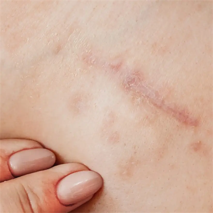 Herstellende Littekenbehandeling met Mesoestetic Panthenol & Organic Silicium Cocktail