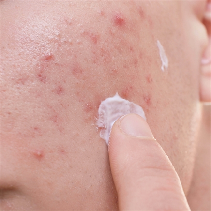 Acne behandelen: wat werkt écht voor een zuivere, rustige huid?