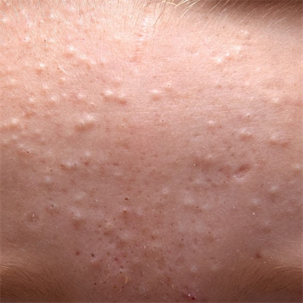 Onzuivere of acnegevoelige huid(acne, mee-eters, verstopte poriën)
