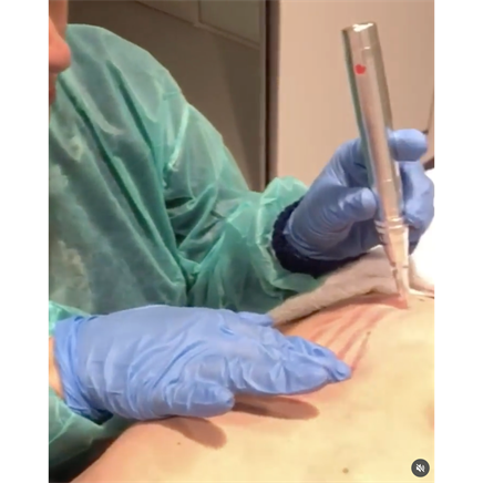 Lichaamslittekens of verhard weefsel na operatie, trauma of brandwonde