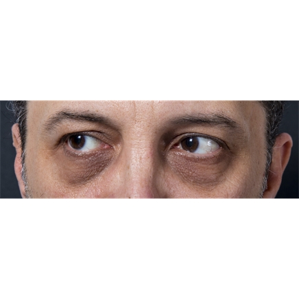 Verhelderende Oogcontourbehandeling met Eye Cocktail & Polynucleotide Infusion
