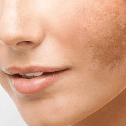 Pigmentvlekken, UV schade of Melasma