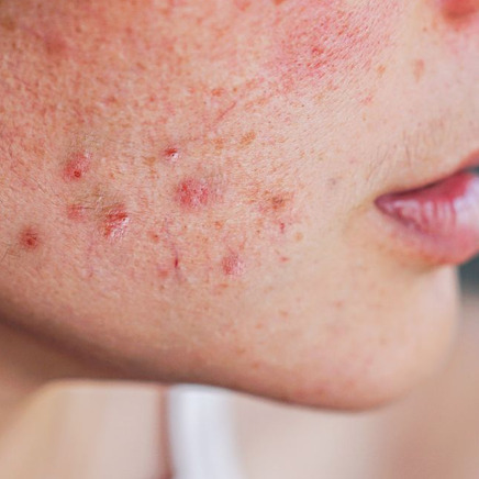 Blog: Eczeem en Psoriasis: tips voor een rustige, gedehydrateerde huid zonder irritatie 