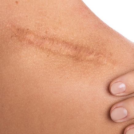 Verkleuringen van vroegere littekens/acne/letsels behandelen