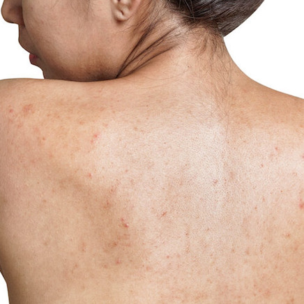 Onzuivere rug of rug met littekens (backne / acne op de rug)