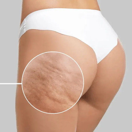 Cellulite of sinaasappelhuid