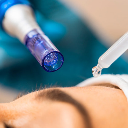 Herstellende Combi Peeling met Needling Facial